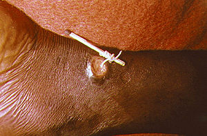 a Guina Worm in a human leg